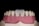 A close-up of a dental model showing human gums and teeth. The model includes two central incisors which are whiter than the surrounding teeth.