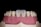 A close-up of a dental model showing human gums and teeth. The model includes two central incisors which are whiter than the surrounding teeth.