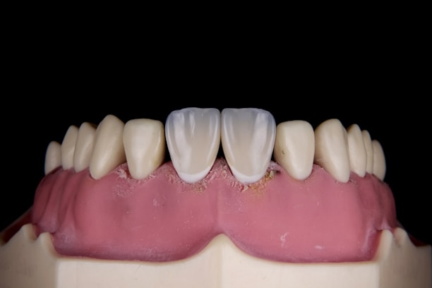 A close-up of a dental model showing human gums and teeth. The model includes two central incisors which are whiter than the surrounding teeth.