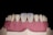 A close-up of a dental model showing human gums and teeth. The model includes two central incisors which are whiter than the surrounding teeth.