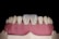 A close-up of a dental model showing human gums and teeth. The model includes two central incisors which are whiter than the surrounding teeth.