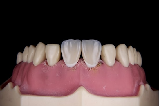 A close-up of a dental model showing human gums and teeth. The model includes two central incisors which are whiter than the surrounding teeth.
