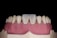 A close-up of a dental model showing human gums and teeth. The model includes two central incisors which are whiter than the surrounding teeth.