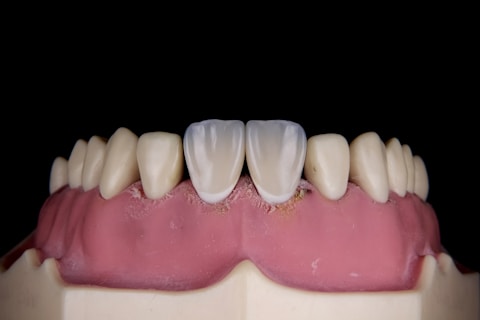 A close-up of a dental model showing human gums and teeth. The model includes two central incisors which are whiter than the surrounding teeth.