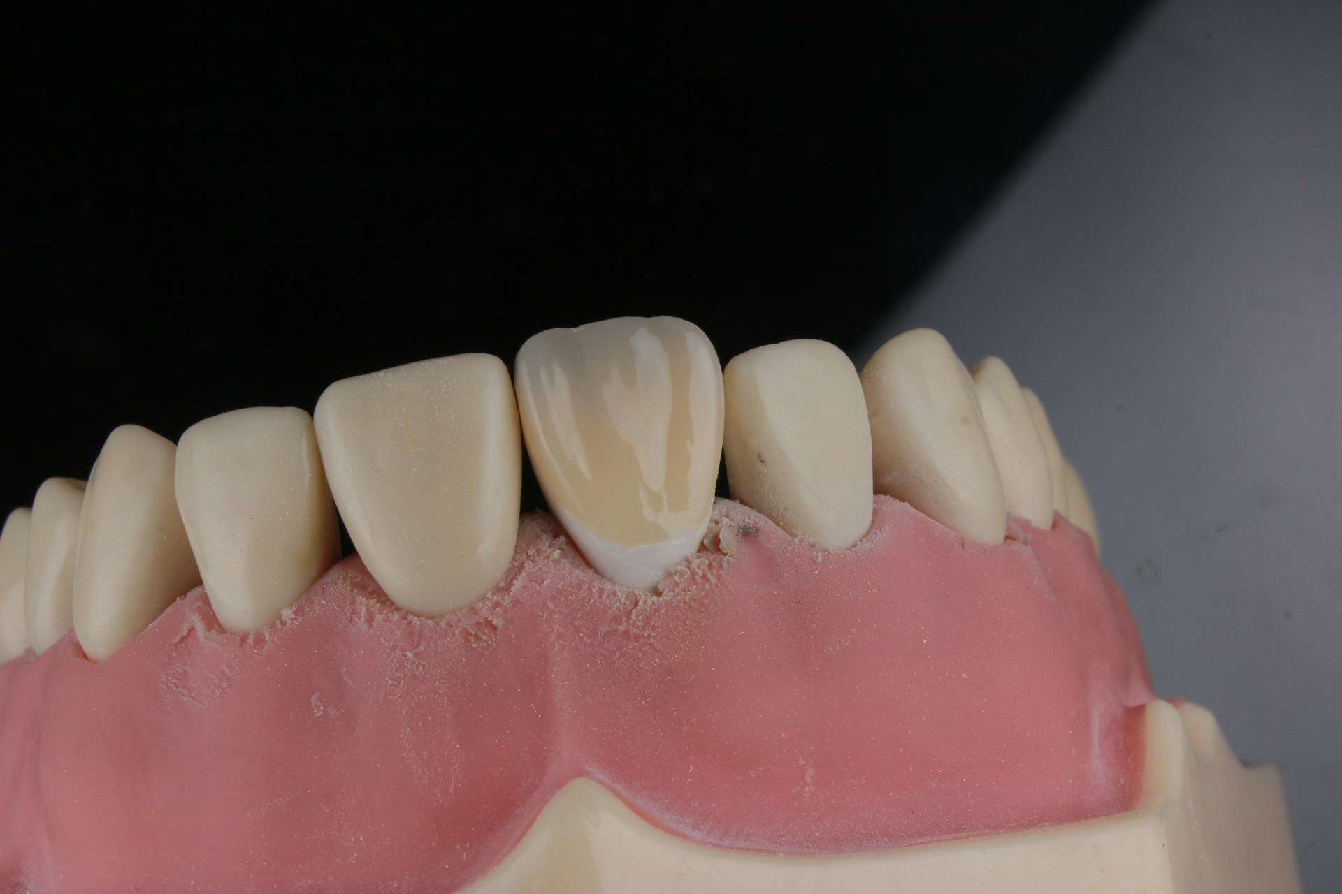 a model of a tooth with a missing tooth