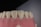 A close-up view of a dental model showing a row of upper teeth, likely made from dental materials for educational or demonstration purposes. The teeth are white and well-aligned, set in a pink gum-like base.