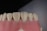 A close-up view of a dental model showing a row of upper teeth, likely made from dental materials for educational or demonstration purposes. The teeth are white and well-aligned, set in a pink gum-like base.