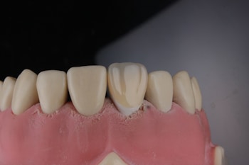 A close-up view of a dental model showing a row of upper teeth, likely made from dental materials for educational or demonstration purposes. The teeth are white and well-aligned, set in a pink gum-like base.