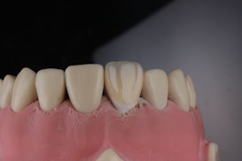 A close-up view of a dental model showing a row of upper teeth, likely made from dental materials for educational or demonstration purposes. The teeth are white and well-aligned, set in a pink gum-like base.