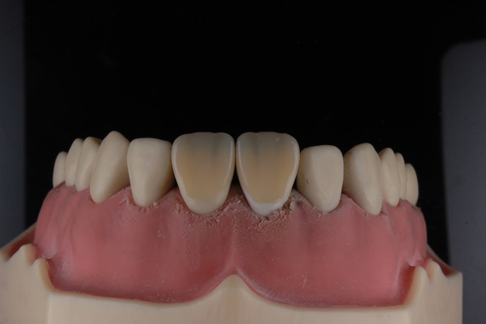 Un modelo de un diente con un diente faltante