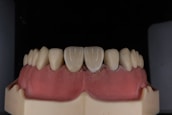 A dental model displaying a set of artificial teeth, with gum-colored material illustrating the mouth structure.
