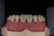 A dental model displaying a set of artificial teeth, with gum-colored material illustrating the mouth structure.