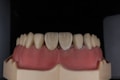 A dental model displaying a set of artificial teeth, with gum-colored material illustrating the mouth structure.