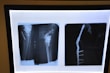 Two X-ray images display a side and front view of a medical fixture in a human bone. Metal pins and screws are visible, indicating a surgical procedure.