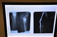 Two X-ray images display a side and front view of a medical fixture in a human bone. Metal pins and screws are visible, indicating a surgical procedure.