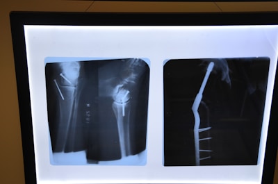 Two X-ray images display a side and front view of a medical fixture in a human bone. Metal pins and screws are visible, indicating a surgical procedure.