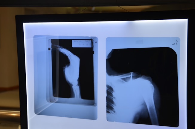 Two X-ray images are displayed on a lightbox, showing different views of a shoulder joint with possible structural concerns.
