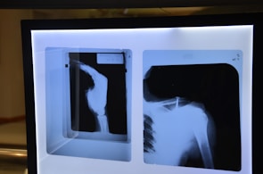 Two X-ray images are displayed on a lightbox, showing different views of a shoulder joint with possible structural concerns.