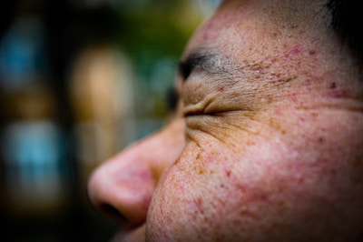 A close-up view of a person's face focusing on the eye area. The skin shows visible pores and slight redness, with the eye appearing to be closed tightly. The background is blurred, emphasizing the facial features.
