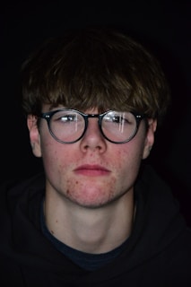 Before and after photos showing the visible reduction of acne and oily skin on a young man's face.