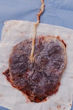 A placenta with the umbilical cord is placed on a white gauze cloth. The placenta has a dark, purplish-red hue with visible veins. The umbilical cord is twisted and appears to be cream-colored with some reddish-brown blood traces.