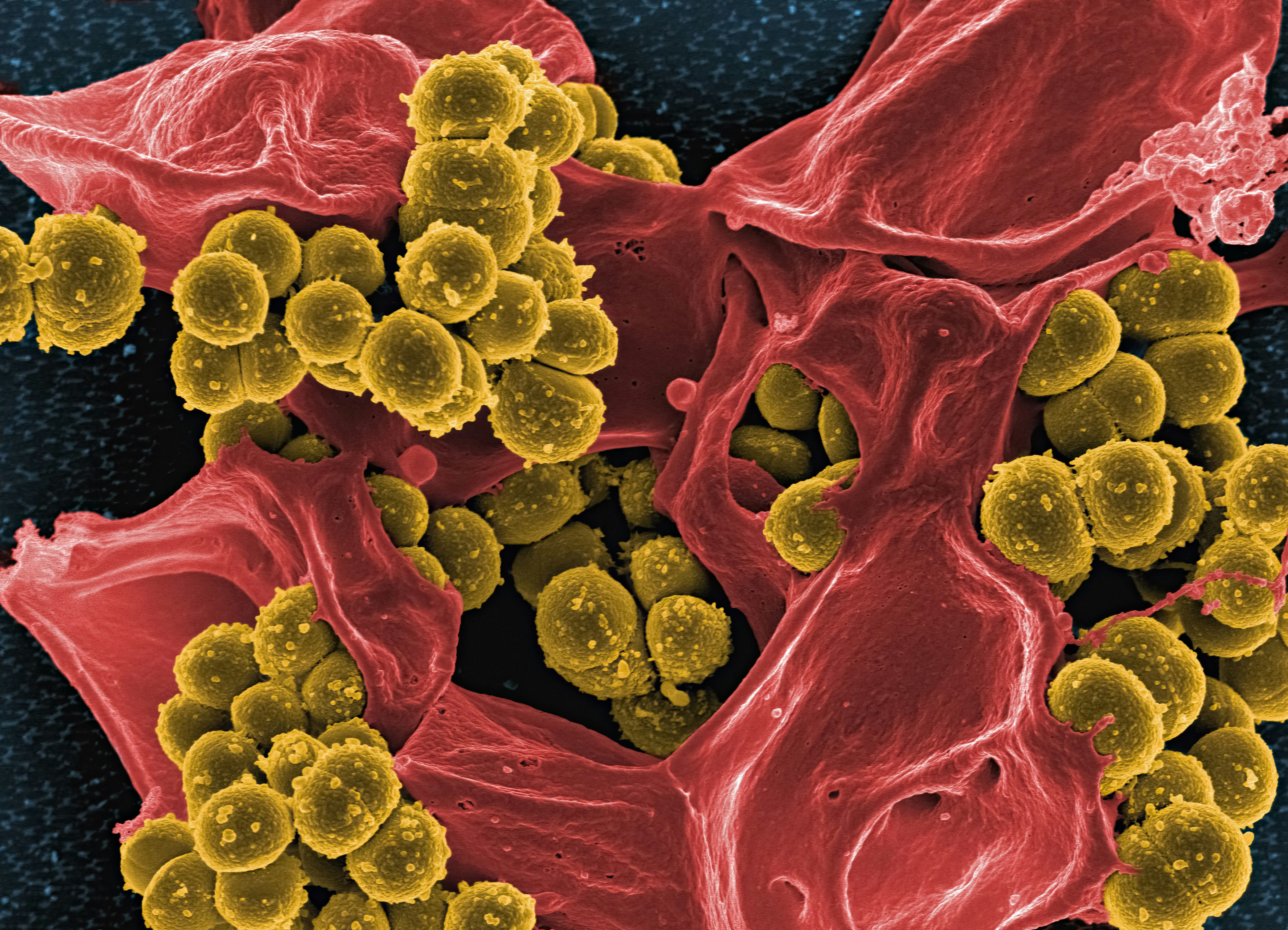 Methicillin-Resistant Staphylococcus aureus (MRSA) Bacteria interacting with a human neutrophil.
