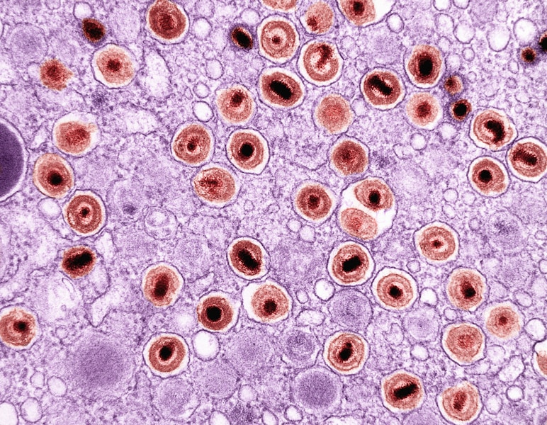 Limfocitarni horiomeningitis: Simptomi, prenos i efikasna dijagnoza virusnog meningitisa od glodara