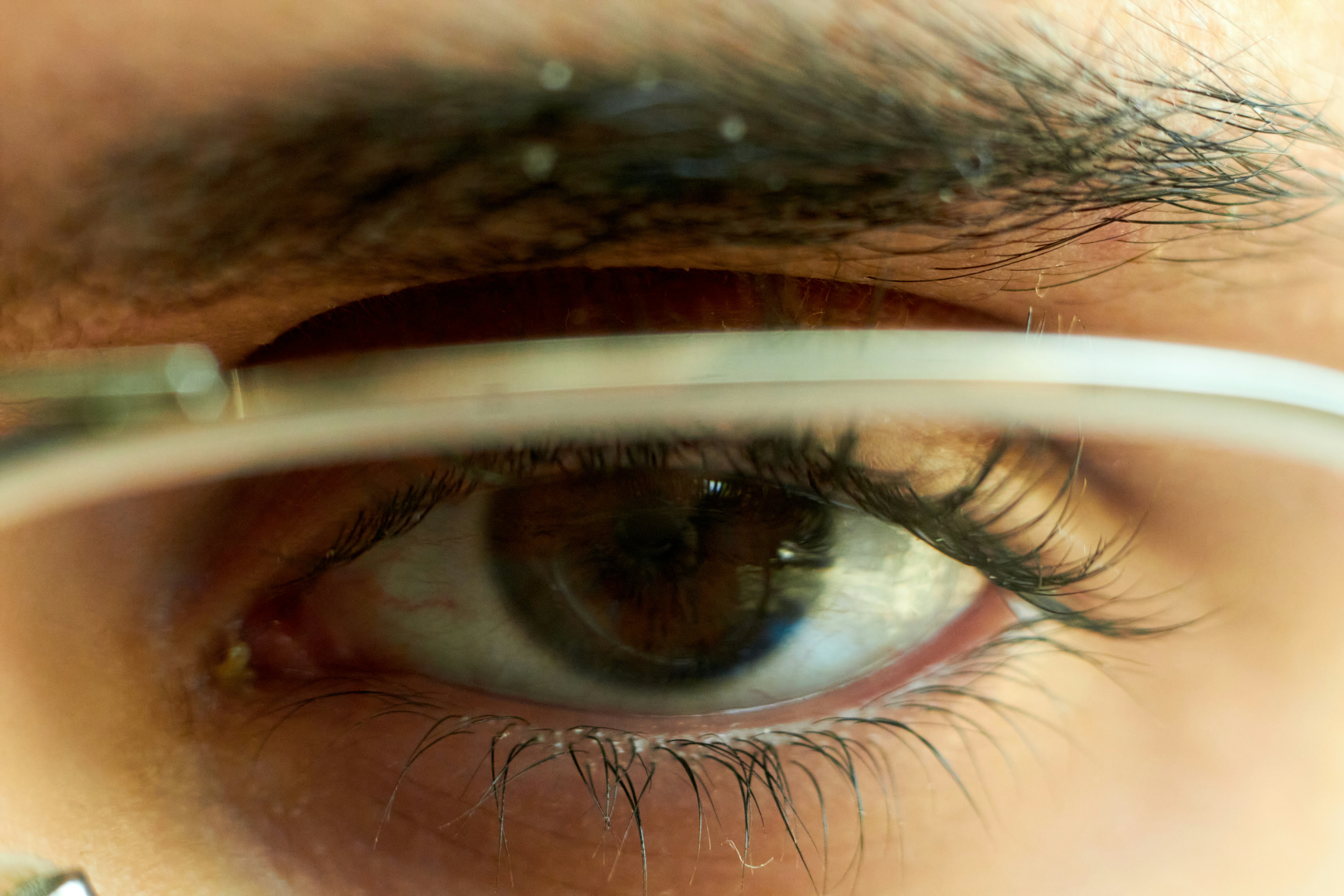 Laser Conjunctival Naevus Removal