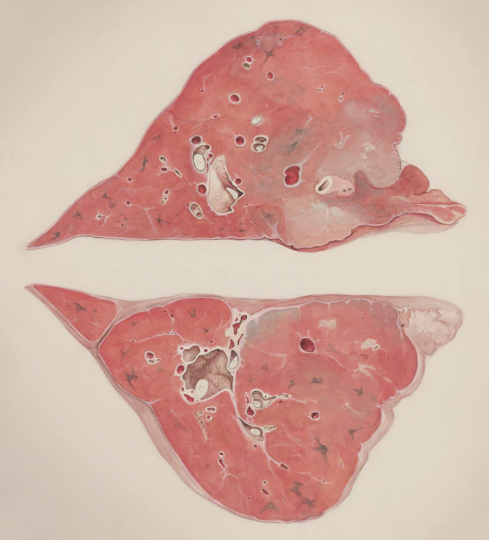 Fatty liver is now the world’s most common liver disease