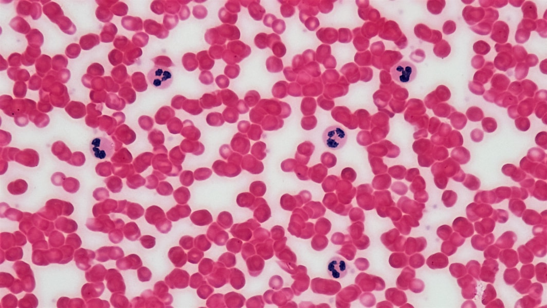 Hemofilija A: Nasledni poremećaj koagulacije, simptomi, dijagnoza i savremeno liječenje