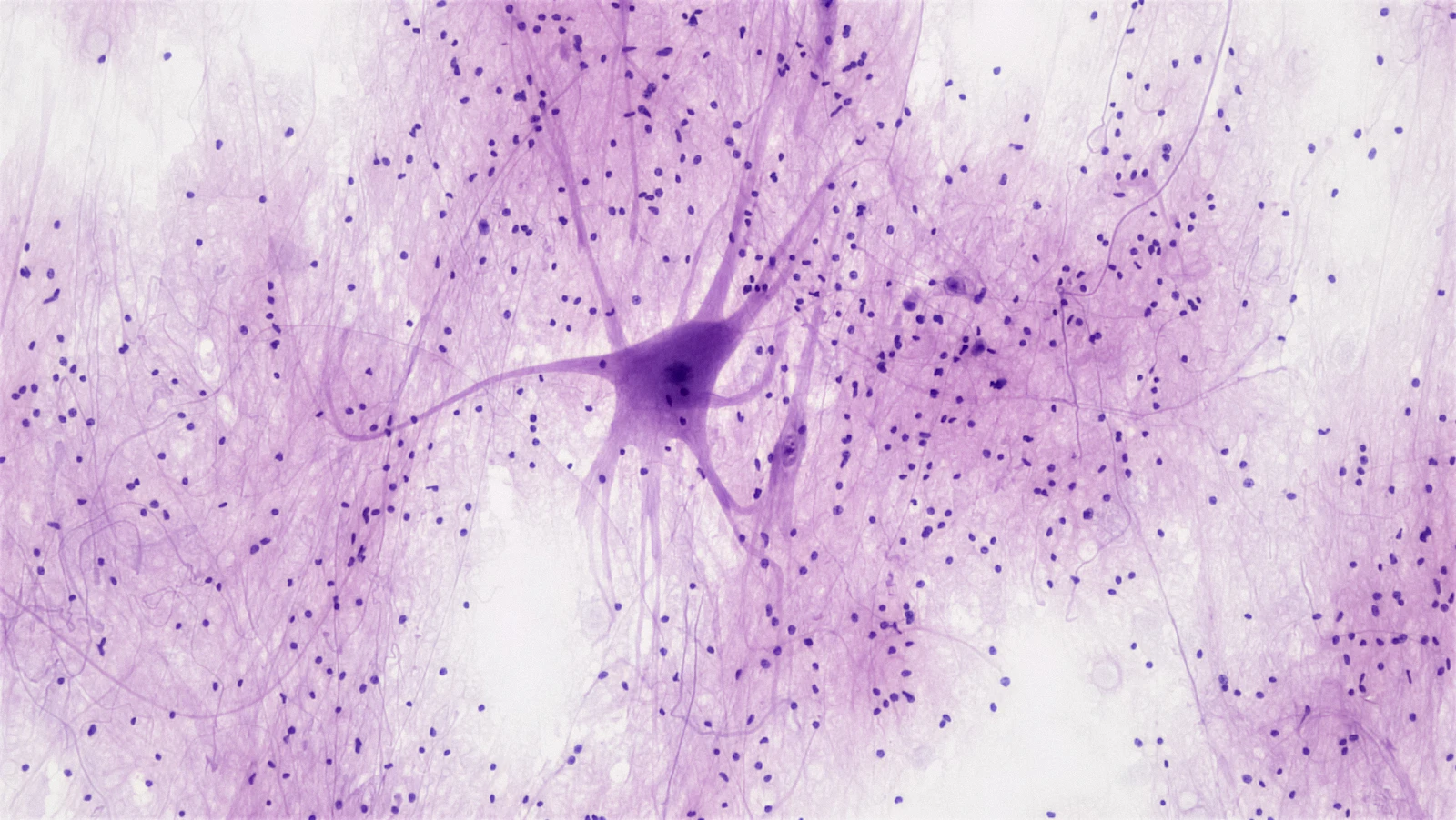 MD Anderson Team Finds a Cancer-Linked Protein May Drive Chronic Nerve Pain, Raising Repurposing Hopes