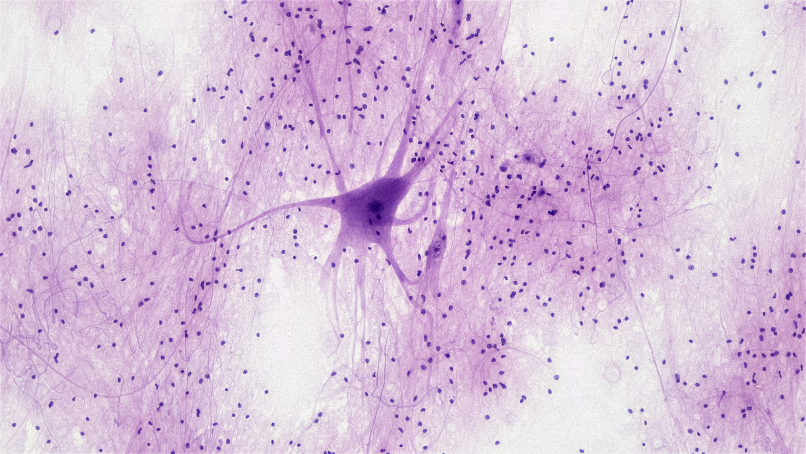 Can Oxalates Trigger Flare-Ups In Multiple Sclerosis?