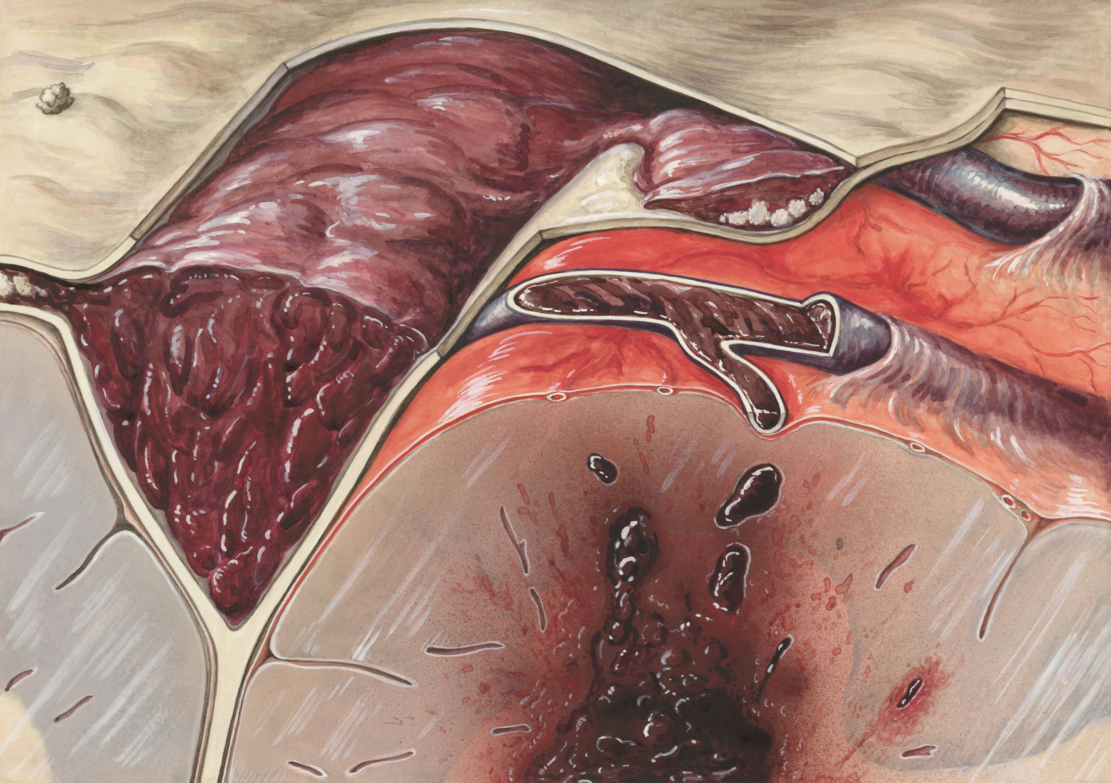 Mucosal Damage and Oxalate-Driven Inflammation: 5 Proven Steps