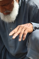 A close up of inflamed joints in the fingers indicating arthritis
