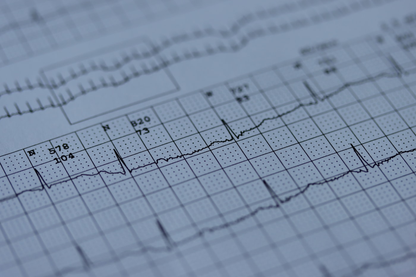 EKG-Ausdruck im Detail – aus Form und Abstand der Zacken liest sich der Herzrhythmus ab