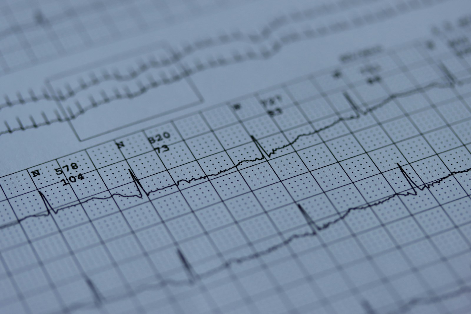 EKG-Ausdruck im Detail – Extrasystolen zeigen sich als zusätzliche Schläge in der Kurve