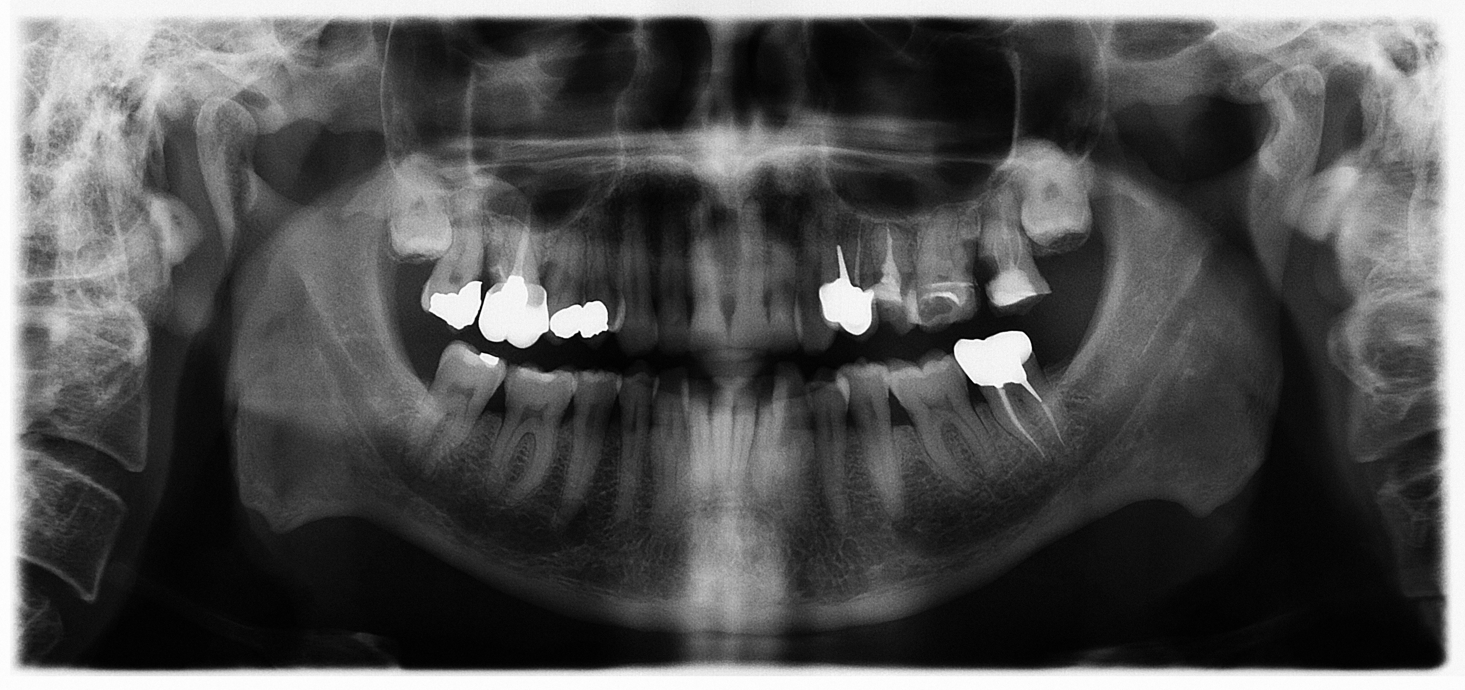X-ray showing successful root canal treatment with proper filling