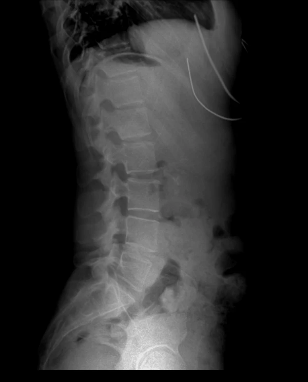 Lumbar spine X-ray interventional procedures