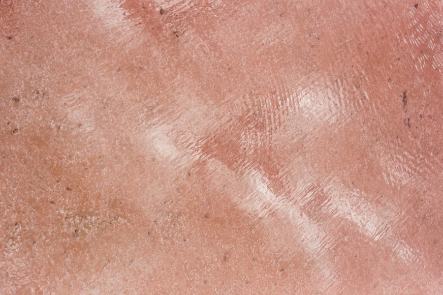 Cylindroma tumori na glavi: simptomi, dijagnoza i efikasno liječenje