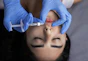 Lips receive an injection of filler.