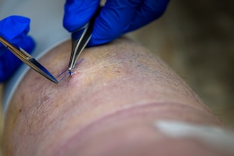Surgeon is using tools to stitch a wound.