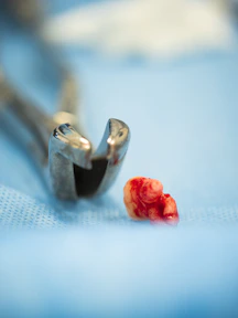 Extracted tooth with dental pliers on a surgical cloth.