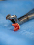 A tooth and forceps after an extraction