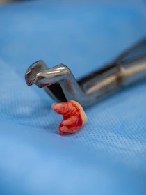 A tooth and forceps after an extraction.
