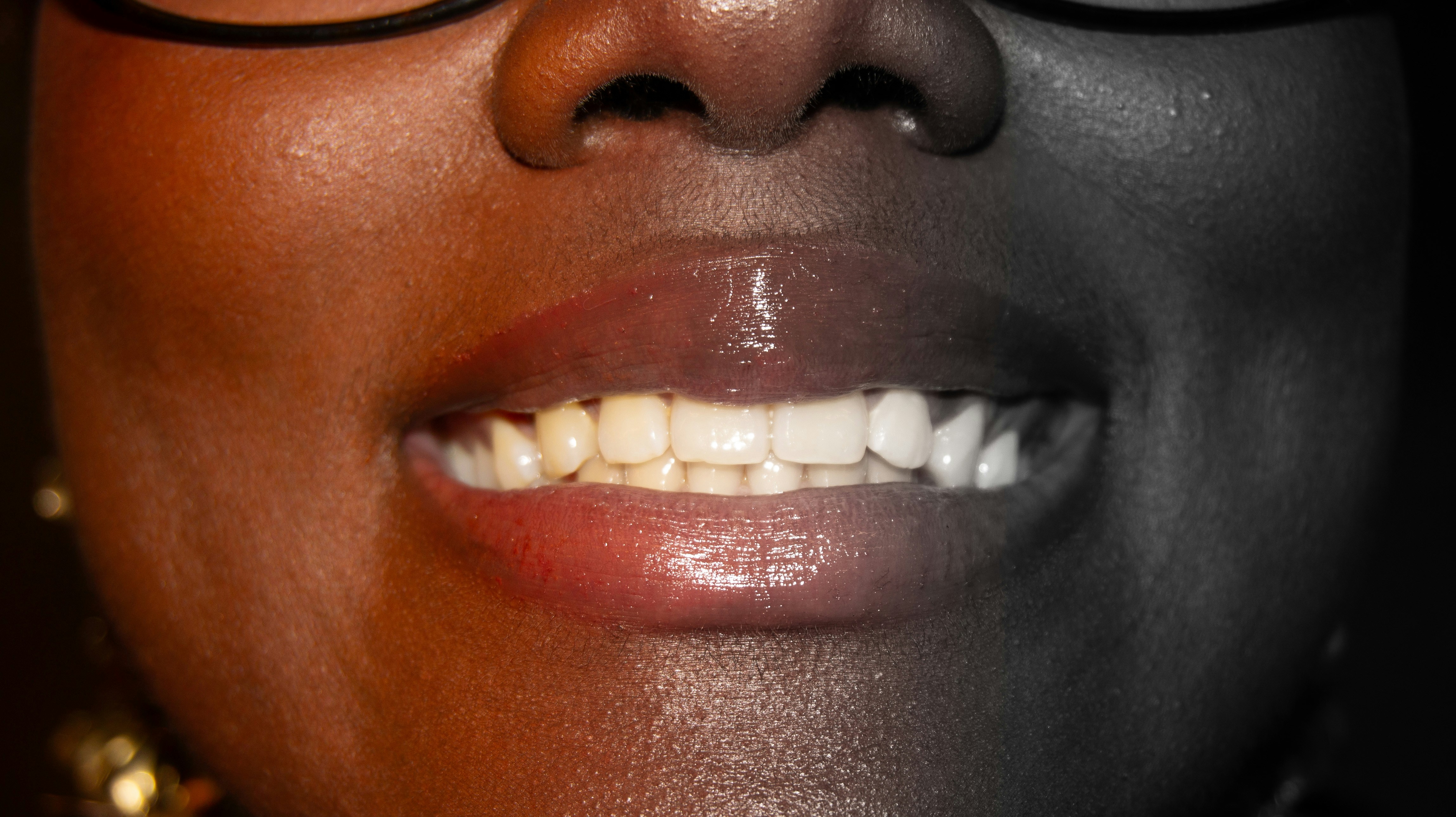 before-and-after comparison of a straightened smile - adult braces cost
