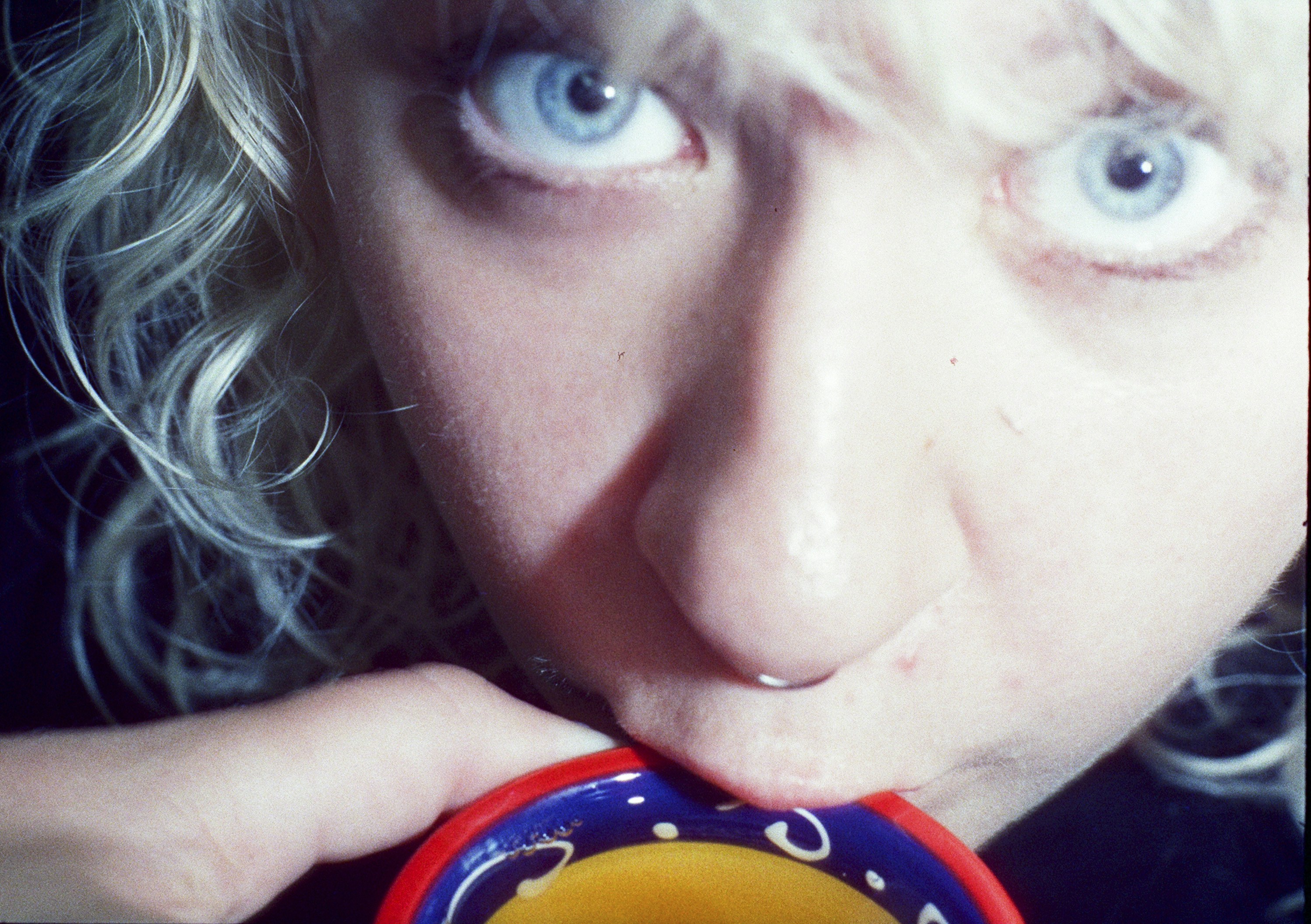 Miniaturisation folliculaire : le processus biologique expliqué simplement