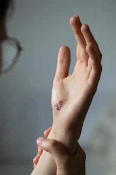 Close up of a stitched wound on a person's wrist