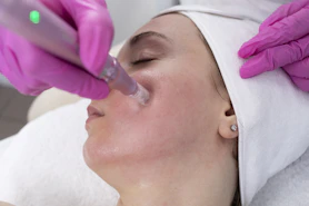 Woman receiving microneedling facial treatment.
