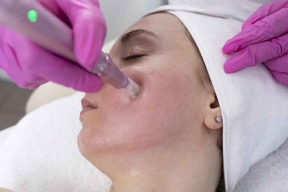 Woman receiving a microneedling facial rejuvenation treatment
