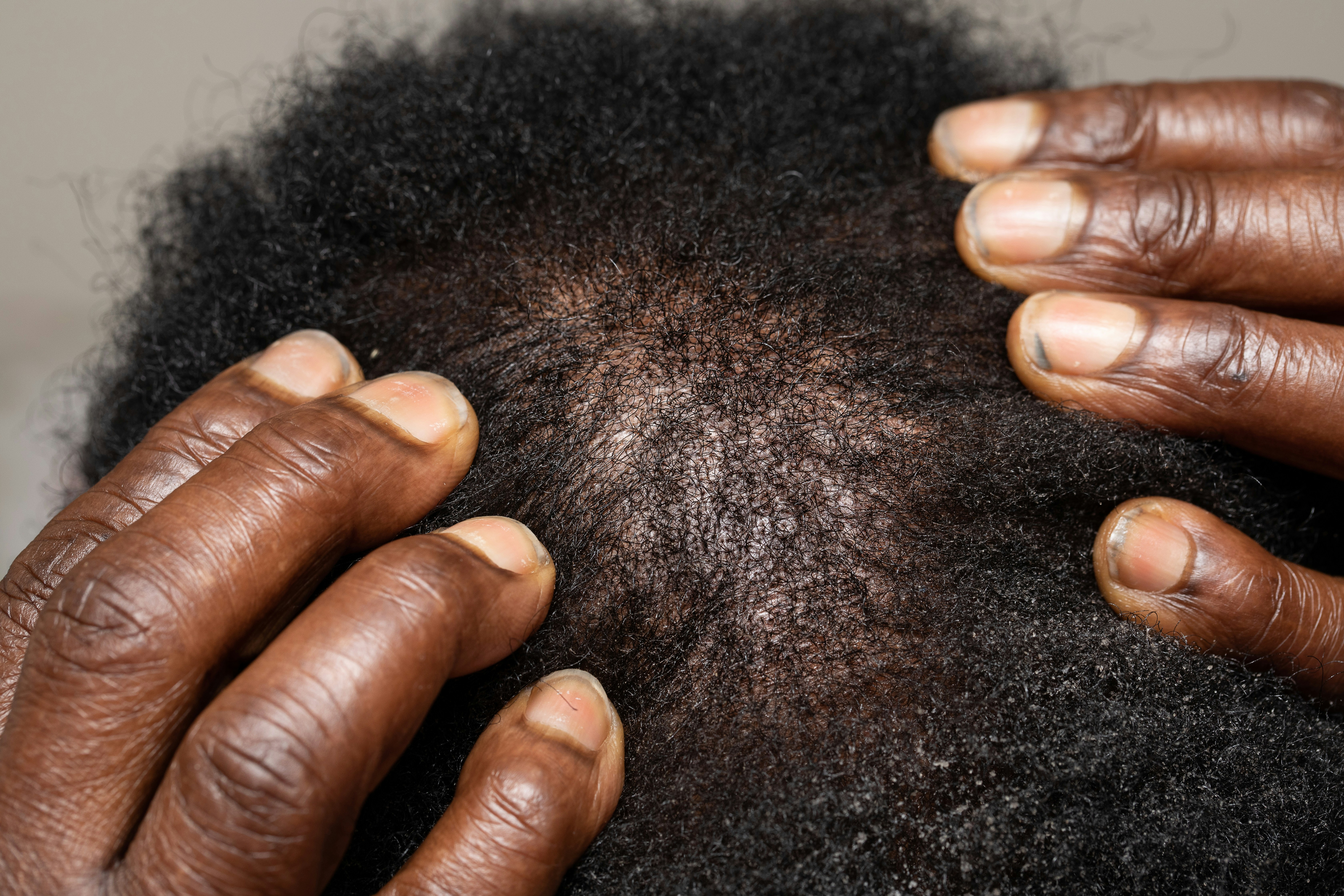 Top view fingers on afro american head scalp top close-up show hair-loss . Hair loss treatment concept
